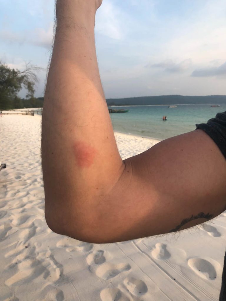 Strong allergic reaction from sandfly bite (UPDATE: Borrelia bacterina) -  Sandflybites